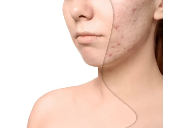 BIO kúra STOP atopickým ekzémům, dermatitis a akné - šetří peněženku