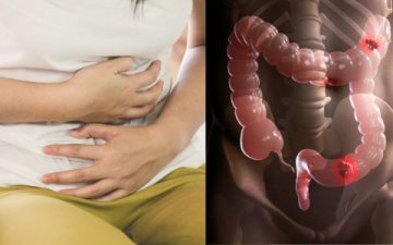 Tichá epidemie? Proč rakovina tlustého střeva postihuje čím dál mladší ročníky