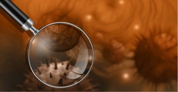Tichý zabiják v našich střevech? Vědci odhalili možný důvod, proč rakovina tlustého střeva čím dál častěji postihuje mladé