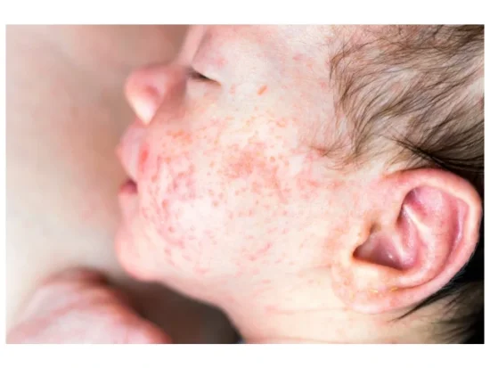 BIO kúra STOP atopickým ekzémům, dermatitis a akné - šetří peněženku