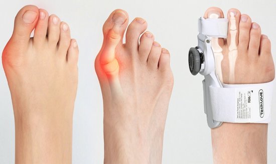 Ortéza na vbočený palec s kloubem Hallux Valgus