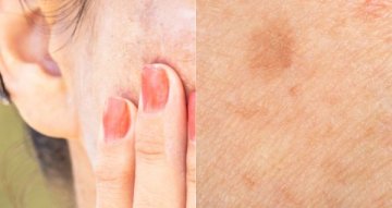 Tajemství krásné pleti: Jak se zbavit pigmentových skvrn přirozenou cestou